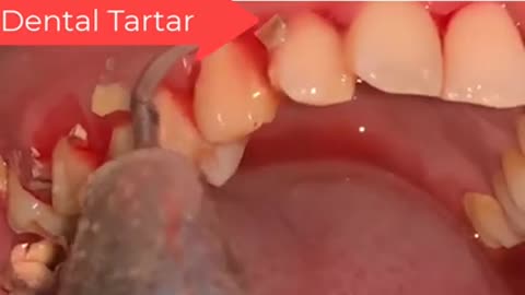 Tartar Dentist 2021 | Satisfying Dental-work
