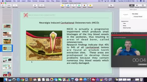 Dental Problems Can Cause Chronic, Systemic Disease! Modern solutions, Cavitations, Mercury. 183