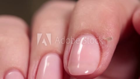 Brittle Nails.. What Causes Nutritionist Says?