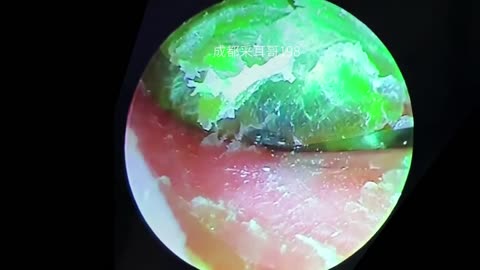 gigantic ear wax removal #38