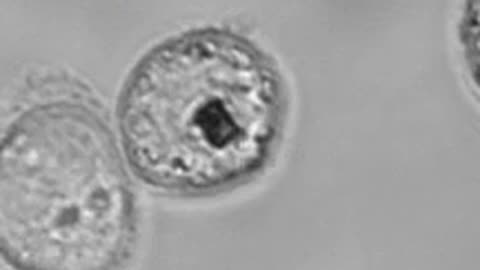 A Nanoelectronic Smart Dust Biosensor or Biochip Inside Cervical Cancer Cells (HeLa Cell Line)