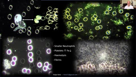 Alarming things inside the blood of the vaccinated..