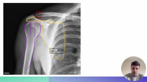 Shoulder Impingement #fitness #gym #pain #shoulder #physicaltherapy