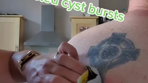 Infected cyst 🤢🤢😳