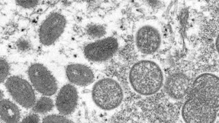 CDC advisers vote in favor of monkeypox vaccine