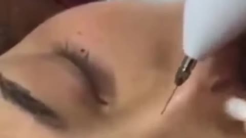 Caneta de plasma - Removedora de manchas e tatuagens na pele