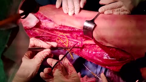 Pioneer transplant moves leg nerves to hand
