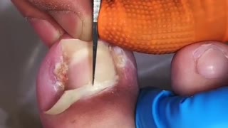 Painful removal of ingrown from toenail