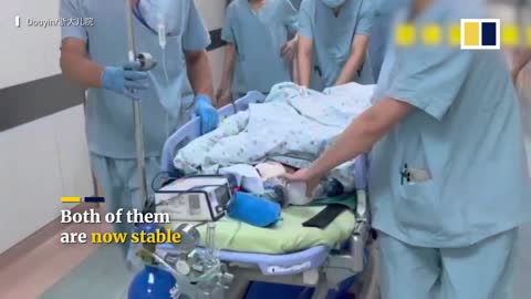 Conjoined twins successfully separated in China