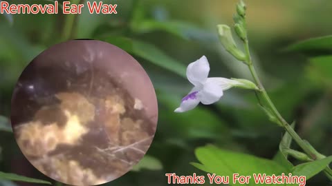 gigantic ear wax removal #2