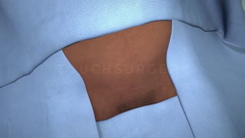 Touch Surgery Simulation - Cesarean Section