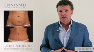 Tummy Tuck Abdominoplasty with Dr. L. Scott Ennis