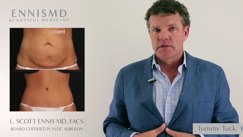 Tummy Tuck Abdominoplasty with Dr. L. Scott Ennis