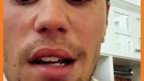 Justin Bieber Shows Mobility in His Face - Ramsay Hunt Syndrome Diagnosis - Justin Recovery Progress