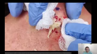 Spine pimple popping reaction