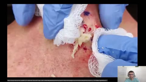 Spine pimple popping reaction