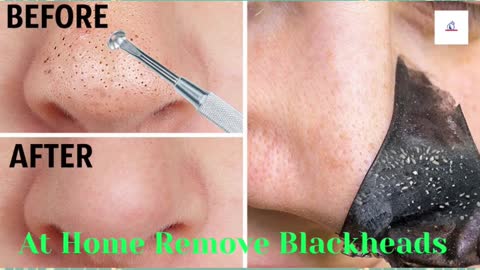 At Home Remove Blackheads | #Shorts1 | #Beauty_tech