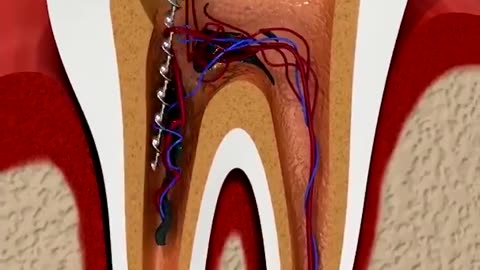 How Root canals work - Root Canal