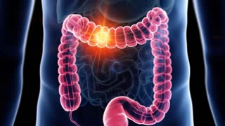 Decoding Efficacy: MIT Unveils the Surprising Truth About Colon Cancer Screenings