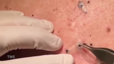 Back Cystic Acne Extraction Blackheads #1