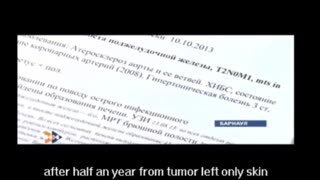 Russian man cures his 4th degree cancer by using simple methods on the internet