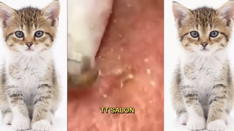 Cystic Acne Extraction This Week, Blackheads Removal, Blackhead Extraction #02