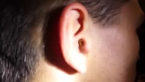 MASSIVE EAR INFECTION - EAR WAX REMOVAL