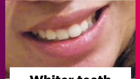 Cleaner Smile Teeth Whitening Kit , Make your smile attractive