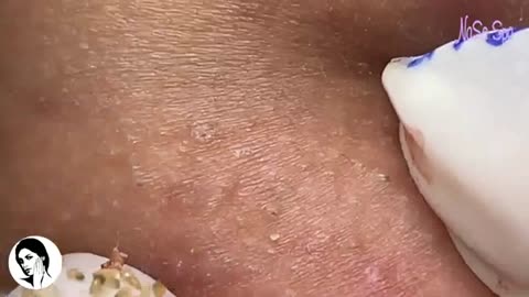 big cystic acne blackheads extraction - retirando cravos