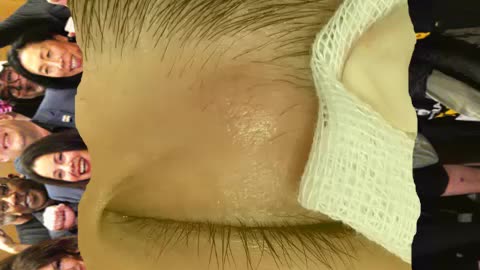 Pimple popping and blackhead