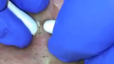 Blackhead Removal - Pimple popping - Acne Treatment - 02