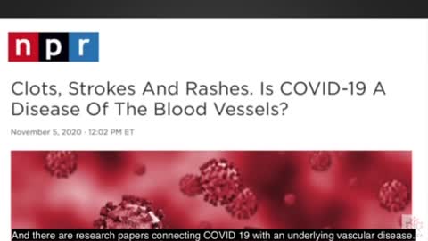 Covid vaccine micro blood clots revealed through d-dimer test