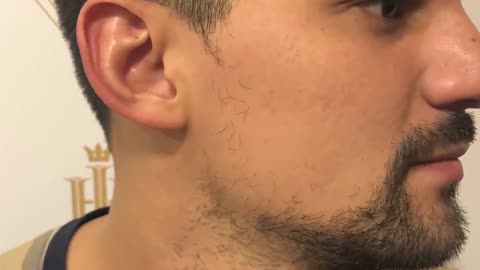 FUE Surgery: Beard Transplant Amazing Results - Before-After