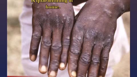 The health ministry has confirmed Jamaica’s third case of monkeypox