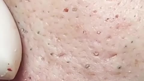 Blackheads