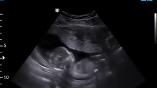 Baby Hiccups in the Womb