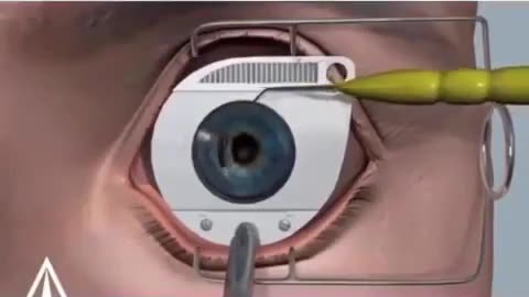 Eye surgery /Medicalhealthfitness