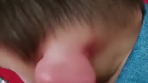 Mosquito bite on the ear