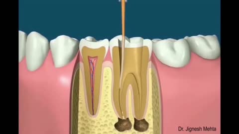 Root Canal Animation