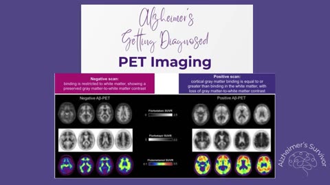 Diagnosing Alzheimer's Disease - PET