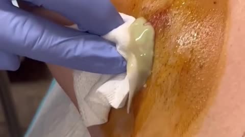 Best Pimple Popping