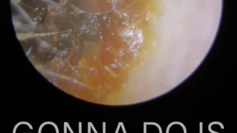 EAR WAX REMOVAL & SQUEAKY CLEAN EAR CANAL