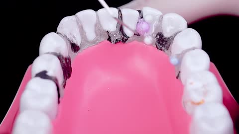 dentist caries