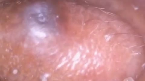 Giants Deep Blackheads, Whiteheads, Big Pimples, Hidden Acne Removal - Best Popping Videos #000033