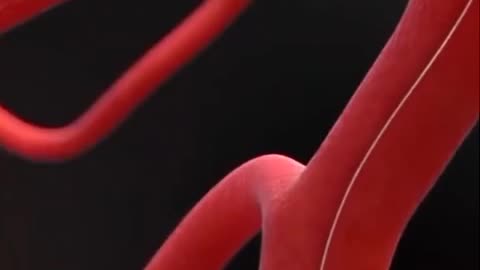 Brain Blood Clot Removal Technique 3D Animation