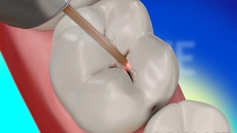 Dental Restoration (Waterlase Laser Dentistry)