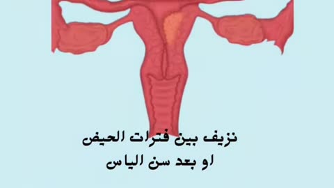 اعراض سرطان الرحم المبكرة