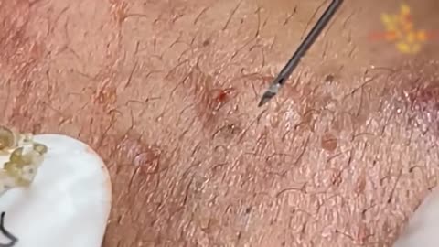 WHITEHEAD EXTRACTIONs in an Acne Patient 2021