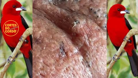 #3 Removing old blackheads. satisfying video.