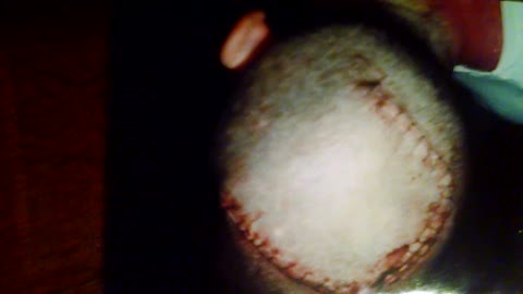 Post brain surgery scar
